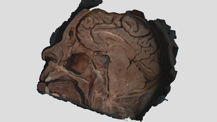MedialMaxillectomyf5Long 3D Model