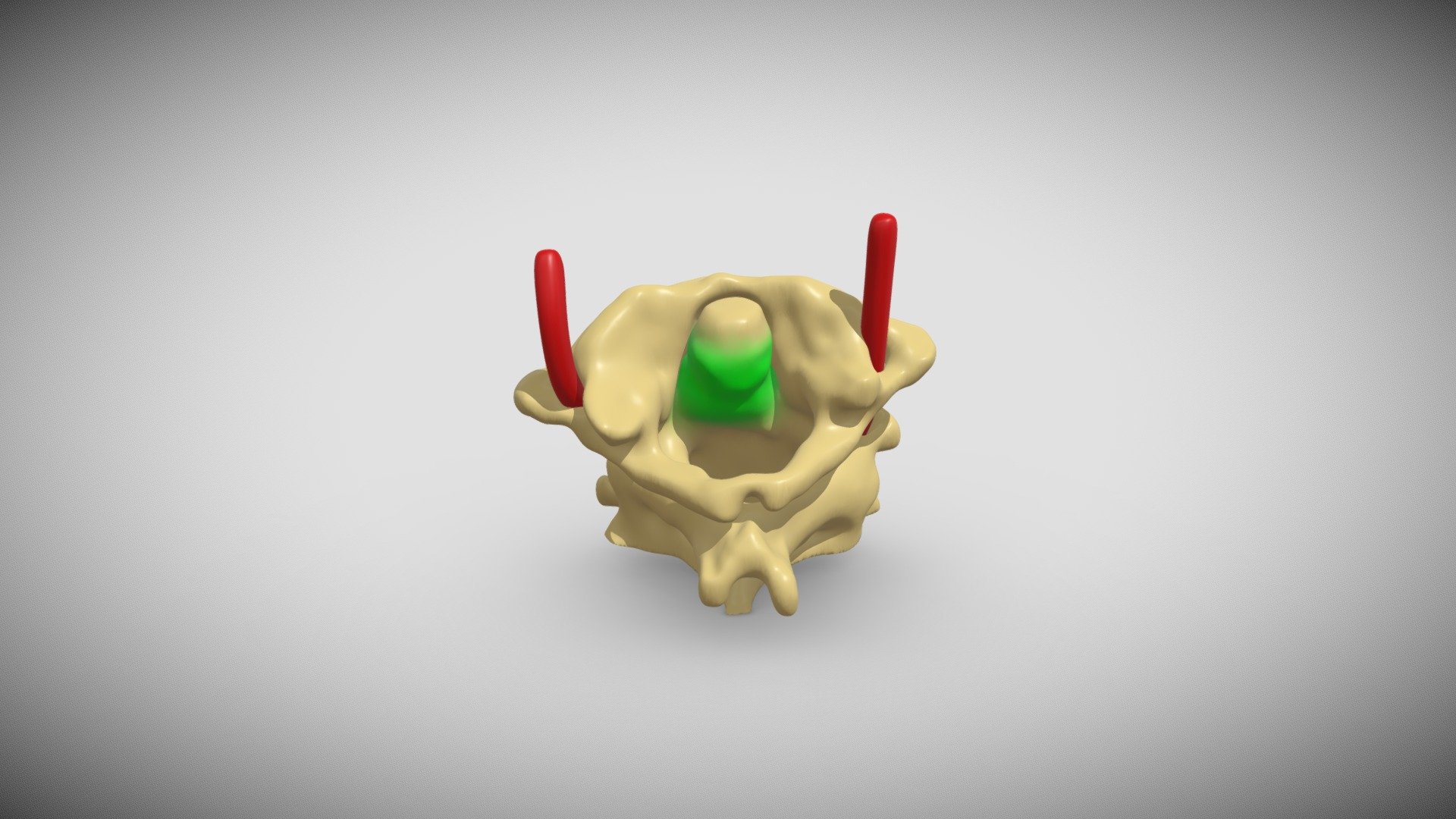 Axial tumor - 3D model by Imre J. Barabás, MD, M.Sc. (@Uzzias18 ...