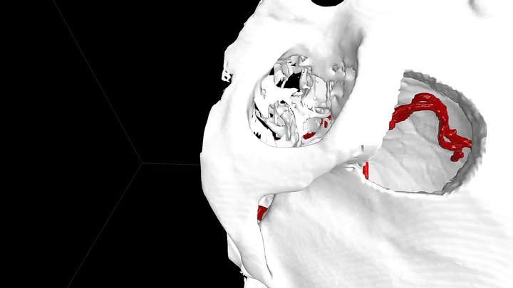 Aco A Supraorbitario3 3D Model