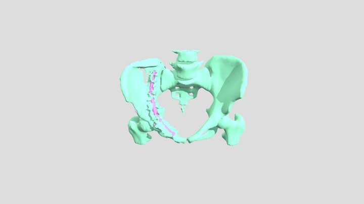 Broken Hip Segmentation - Exam 3 3D Model
