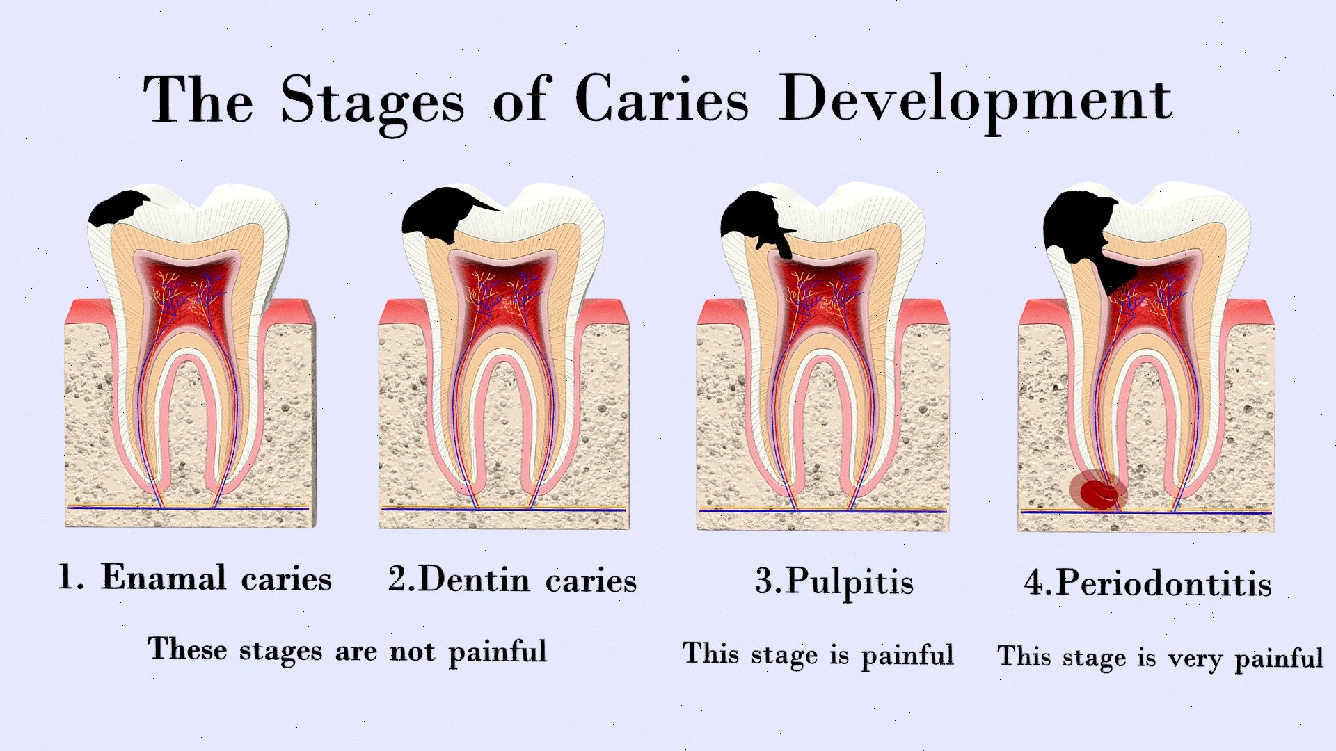 dental caries progression