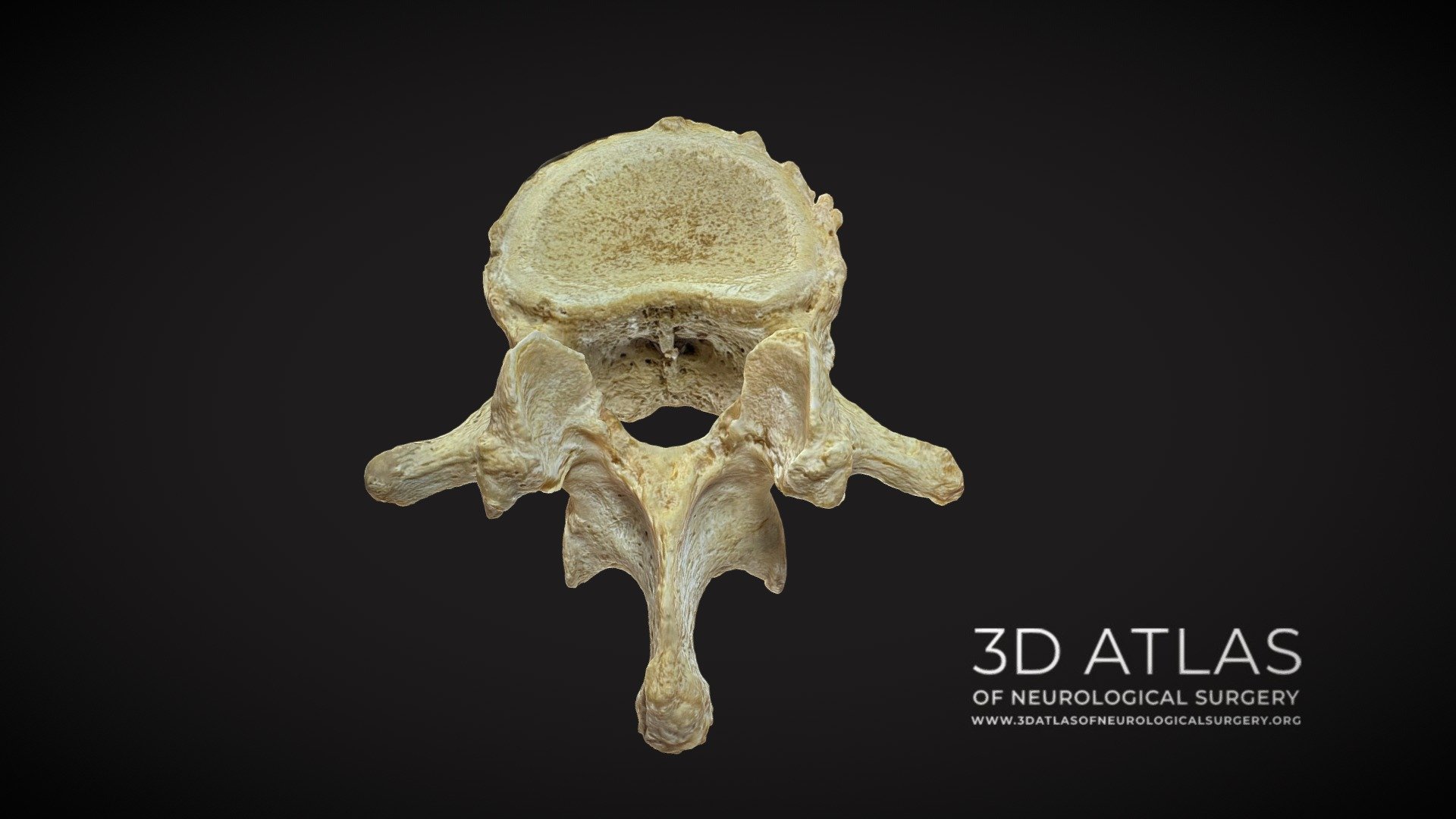 Lumbar spine bone anatomy - 3D Atlas of Neurological Surgery