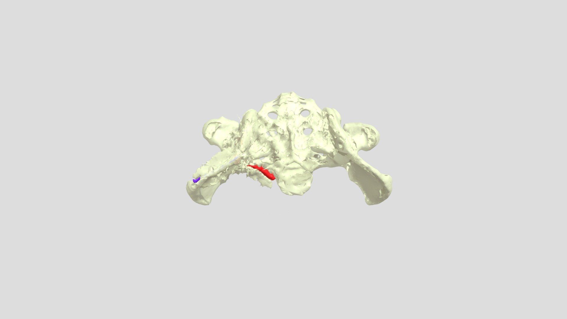 Exam_Three_Gustilo_Pelvix