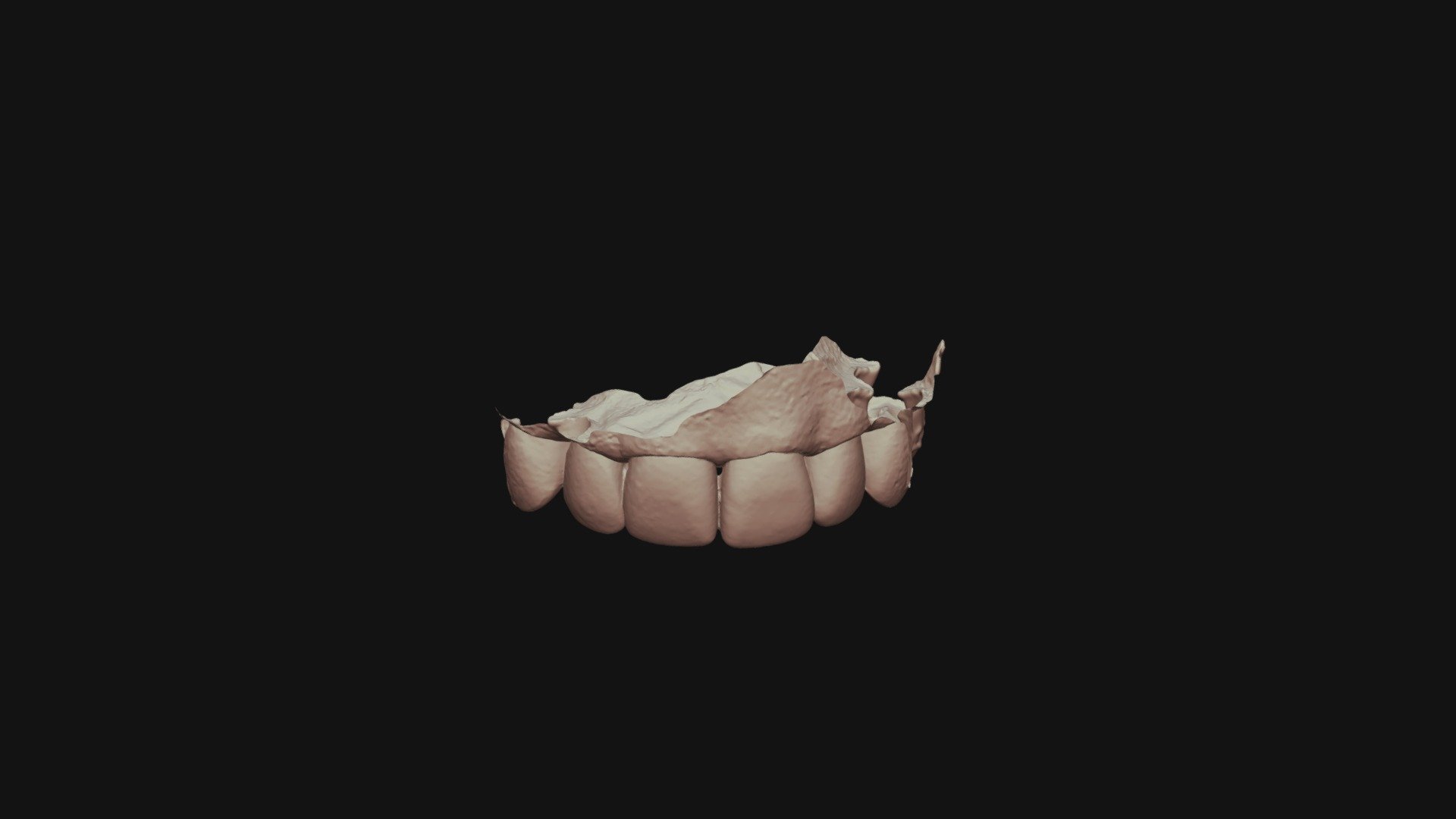 G13tooth#9class3prep1 Upper Jaw (1)