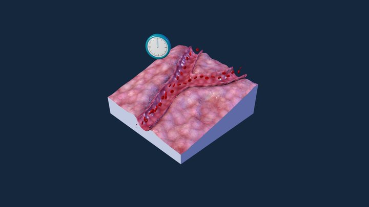 Transient Ischemic Attack 3D Model