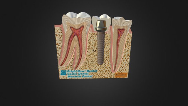 Single Tooth Implant Model 3D Model