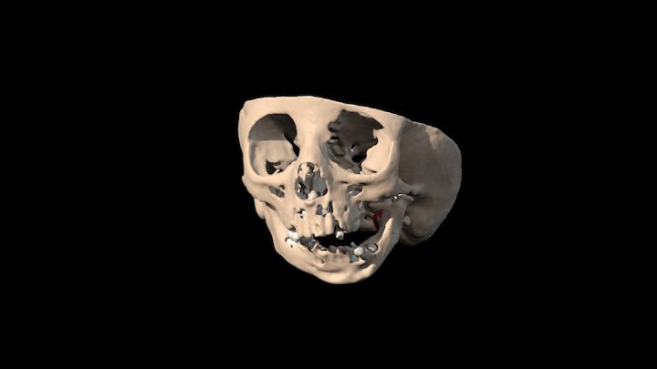 Atipical Ankyloses 3D Model