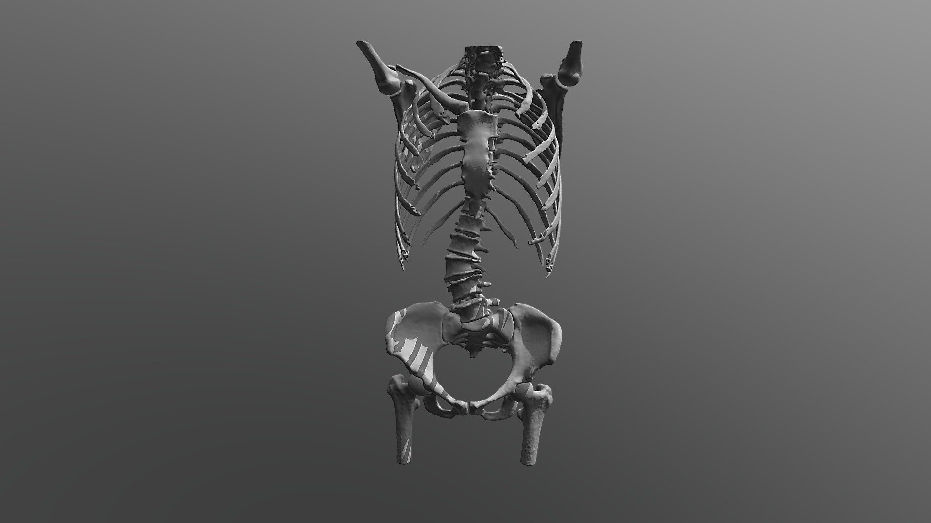 Scoliosis - Download Free 3D model by valchanov (@valchanov) [b13dc14