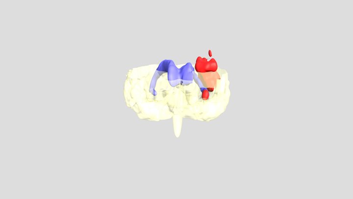 Ischemic Stroke Model 3D Model