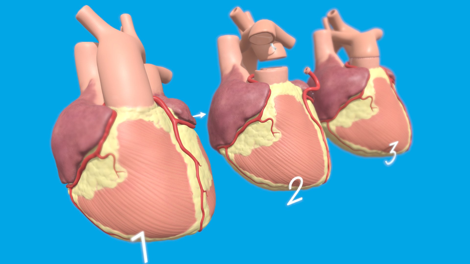 Arterial Switch Procedure - 3D model by Children's Hospital Colorado  Medical Media (@CHCOMedicalMedia) [b1d2071]