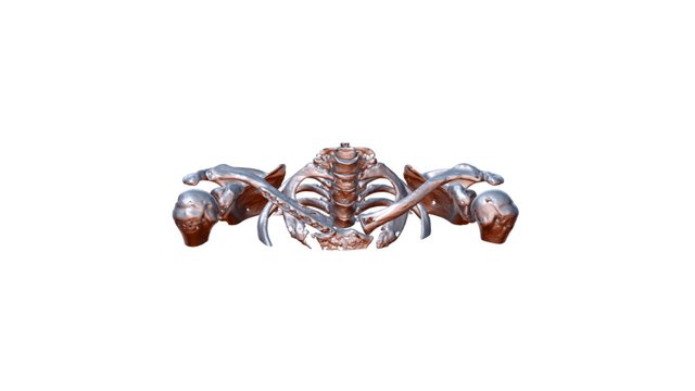 Right Clavicle post operative 3D Model