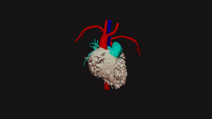 Right Arch, Aberrant left subclavian, pda 3D Model