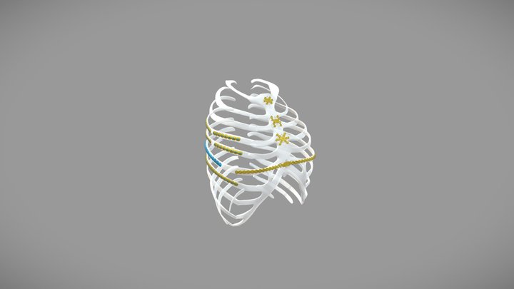 胸壁内固定系统 3D Model