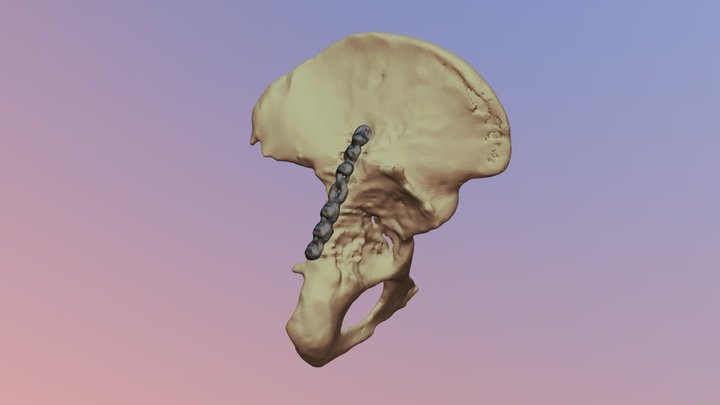 Planeamiento quirúrgico 3D de Cadera 3D Model