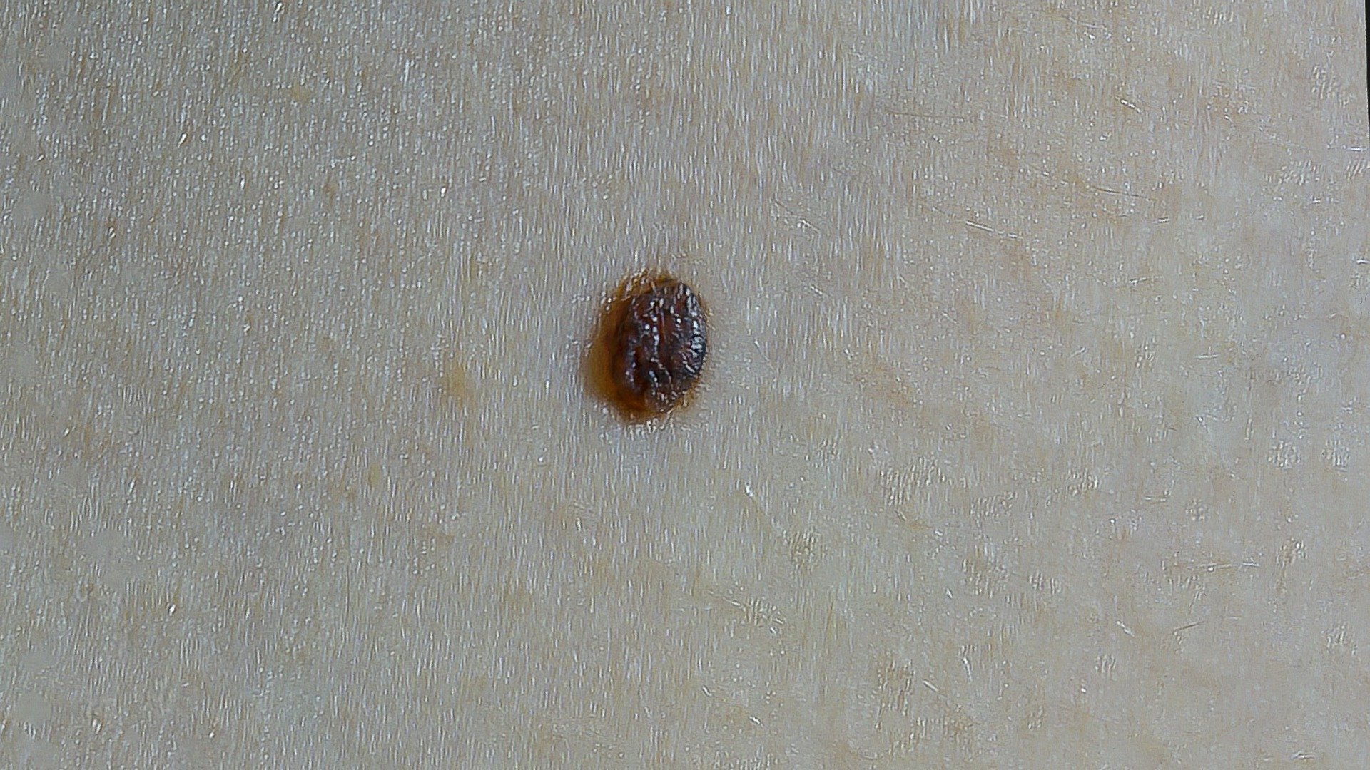 grain de beauté 001