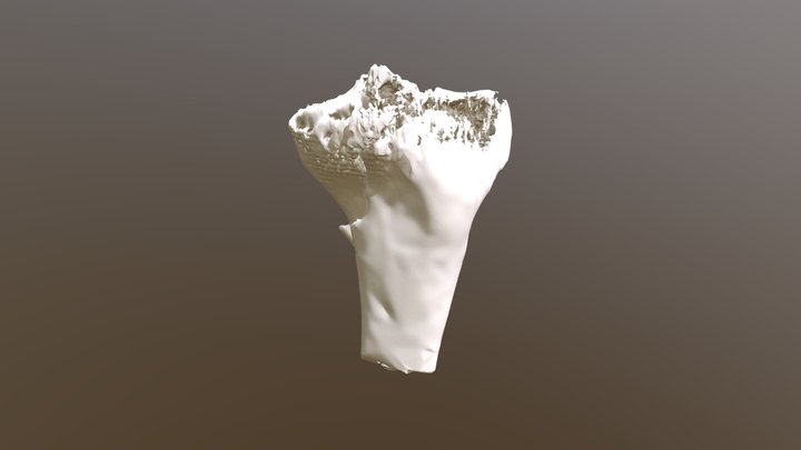 Tibia Plateau Fracture 3D Model