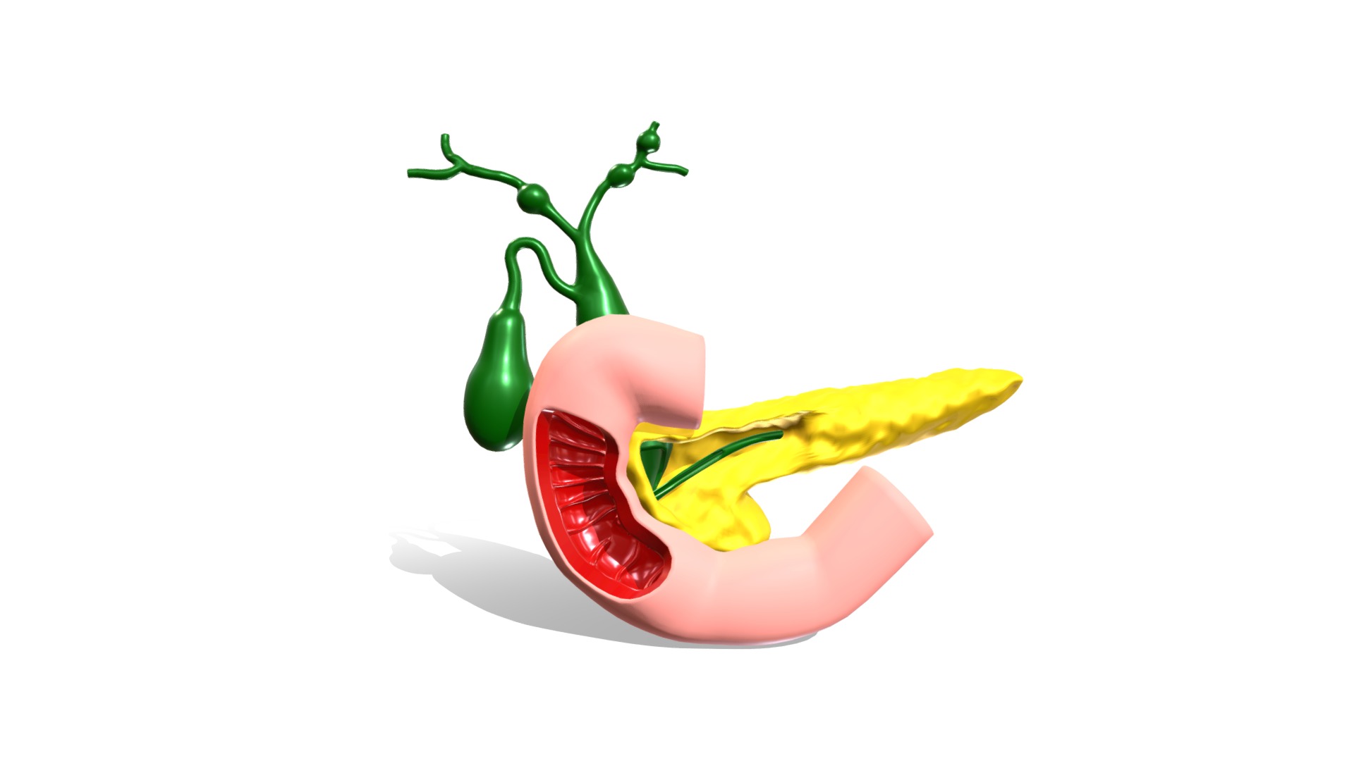 3D model Type 4 – Choledochal Cyst / Pediatric Surgery - This is a 3D model of the Type 4 - Choledochal Cyst / Pediatric Surgery. The 3D model is about a red and yellow pepper.