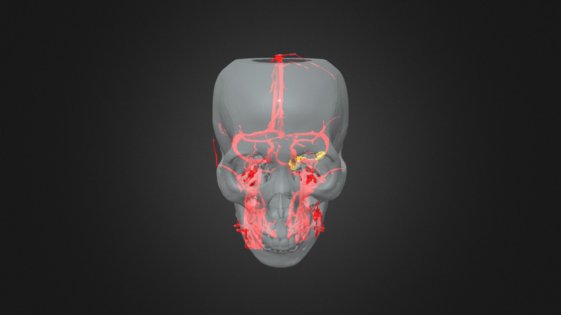 petrosal tumour 1
