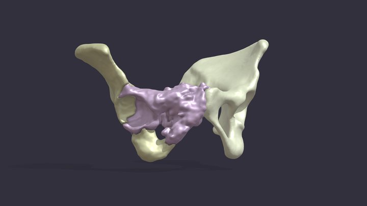 3D Model of Pelvic Tumor 3D Model