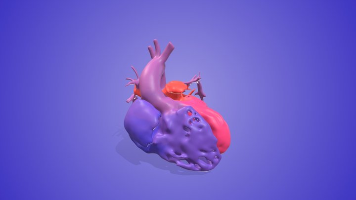 Pulmonary Atresia with VSD and MAPCAs 3D Model