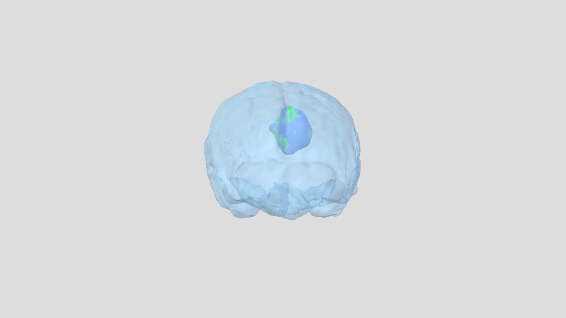 MRI Brain Tumor Segmentation