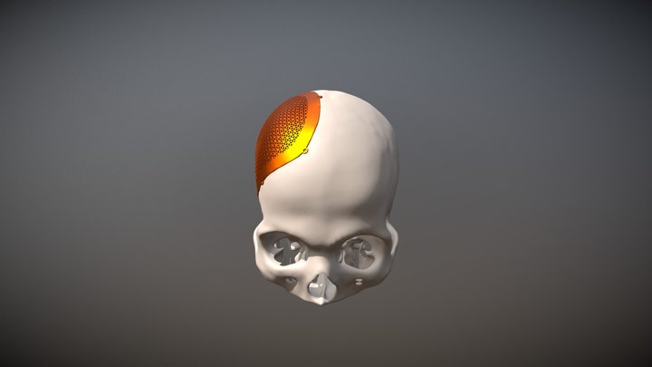Protese de titanio 3D Model