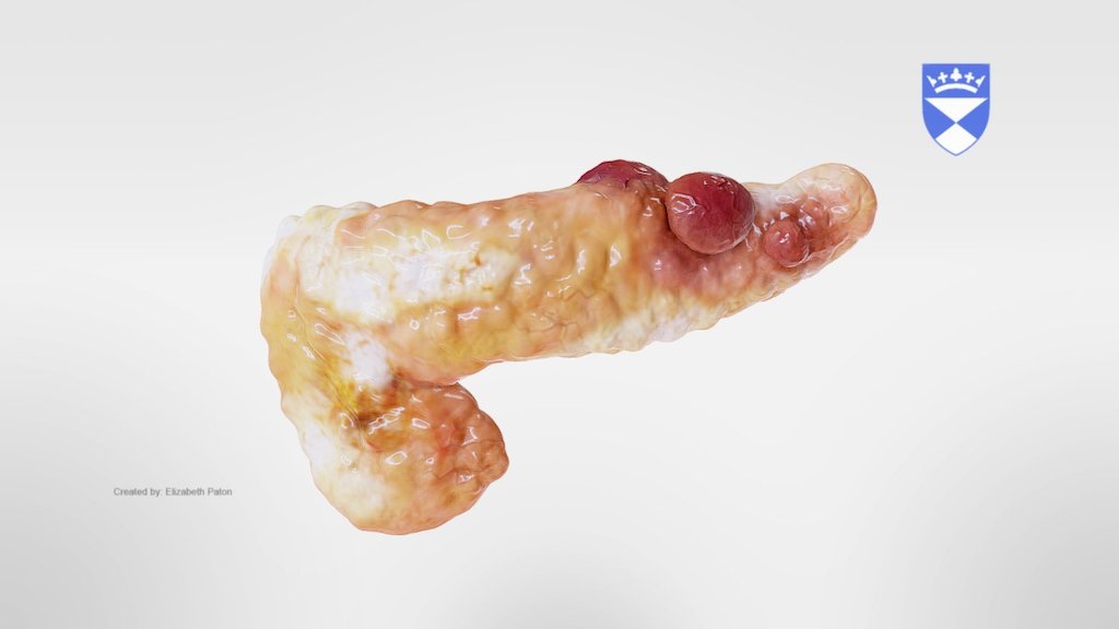 Chronic Pancreatitis