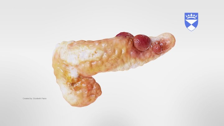 Chronic Pancreatitis 3D Model