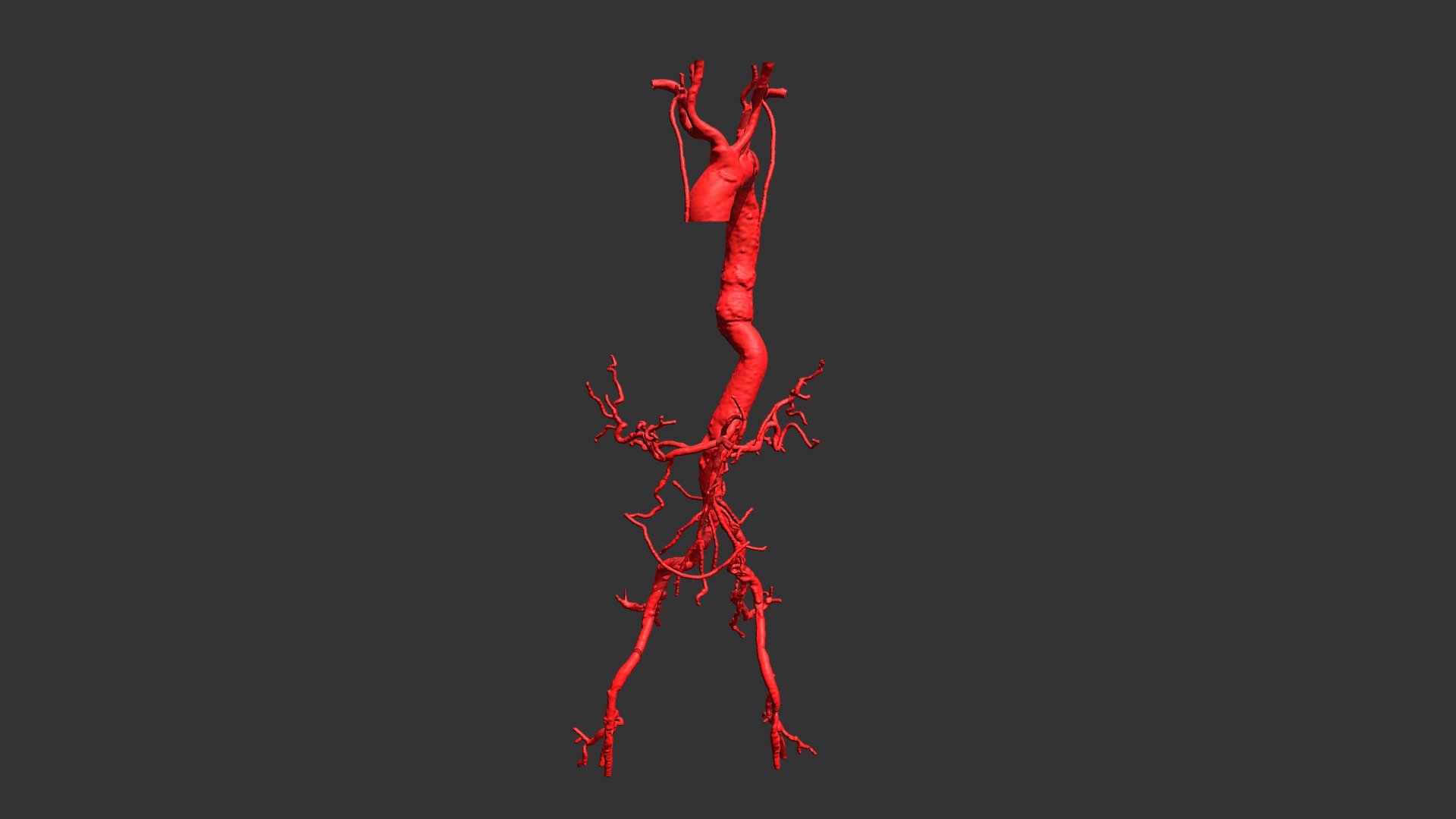 Thoracoabdominal aortic aneurysm - postoperative