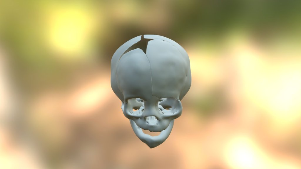 Coronal Synostosis Skull