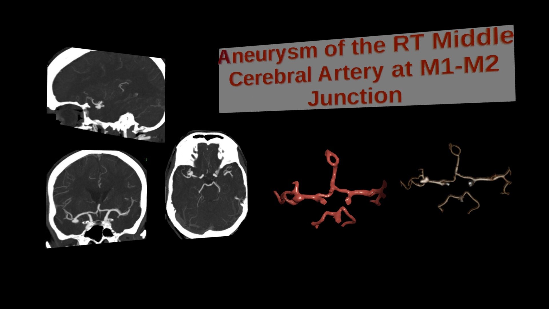 Right Middle Cerebral Artery Aneurysm
