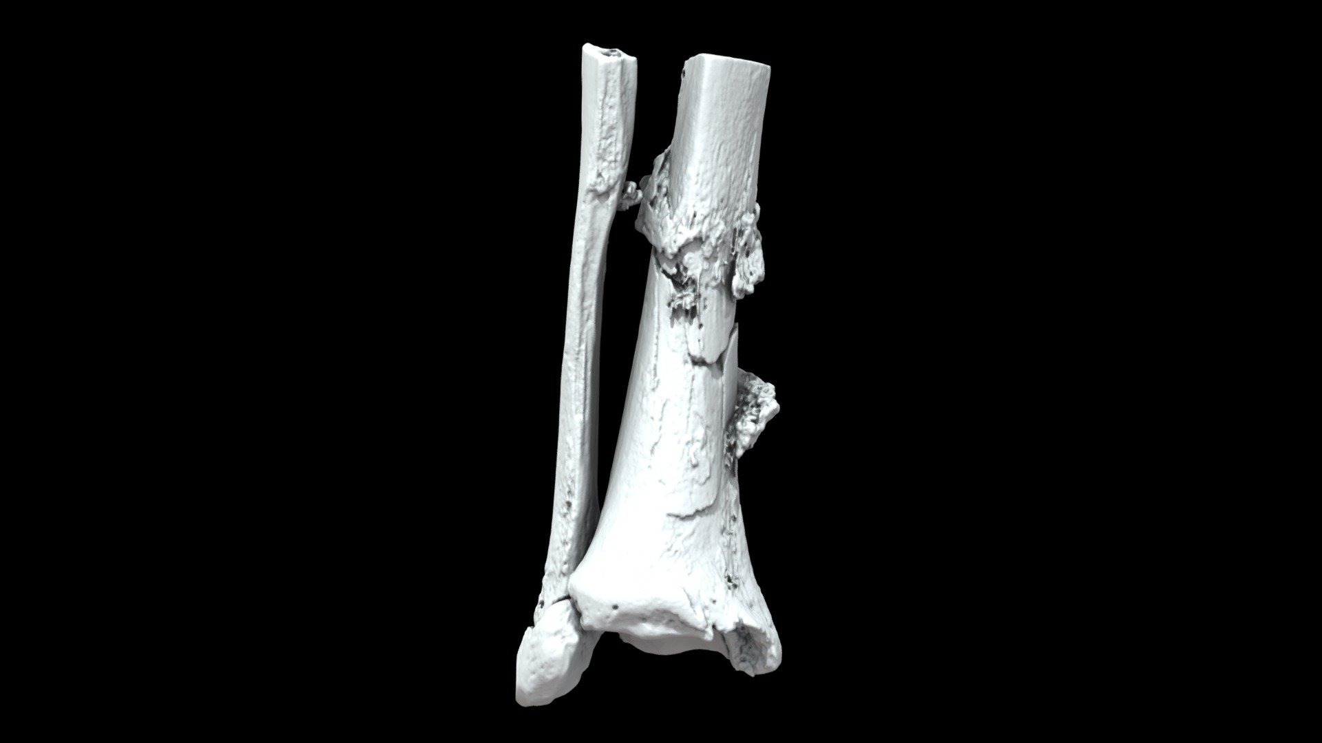 Tibia/fibula w osteomyelitis (VCU_3D_5288)