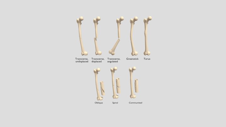 Types of fractures 3D Model