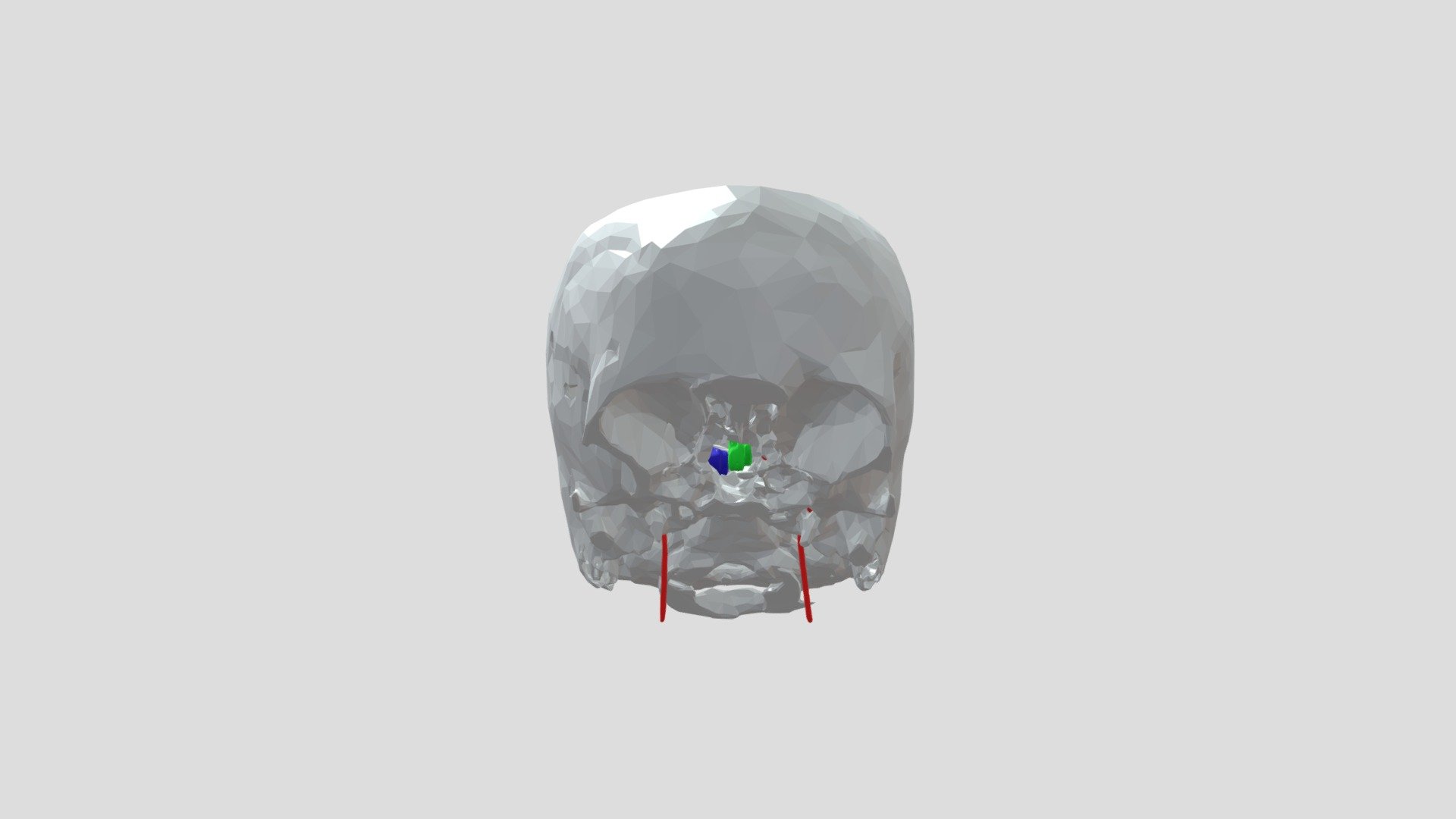 Hypophiseal Tumor