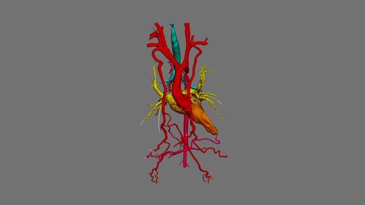 Interrupted Aortic Arch 3D Model