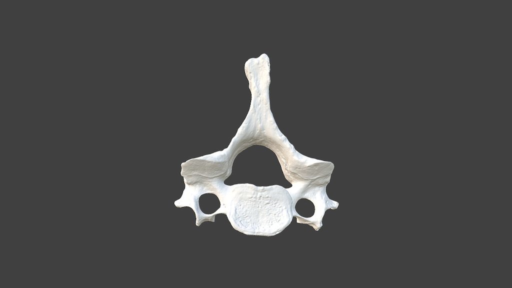 Cervical Vertebra 3