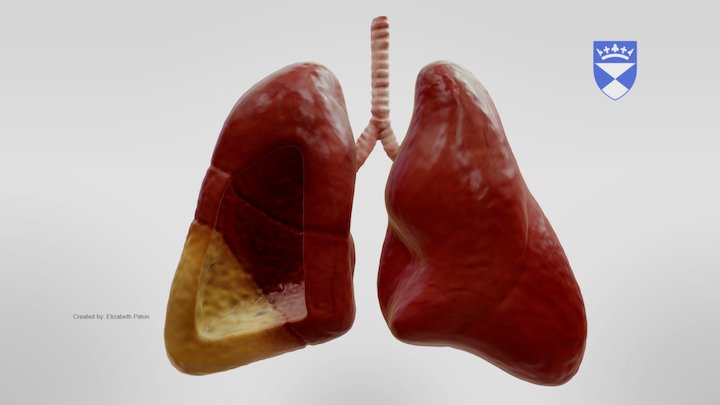 Aspiration Pneumonia 3D Model