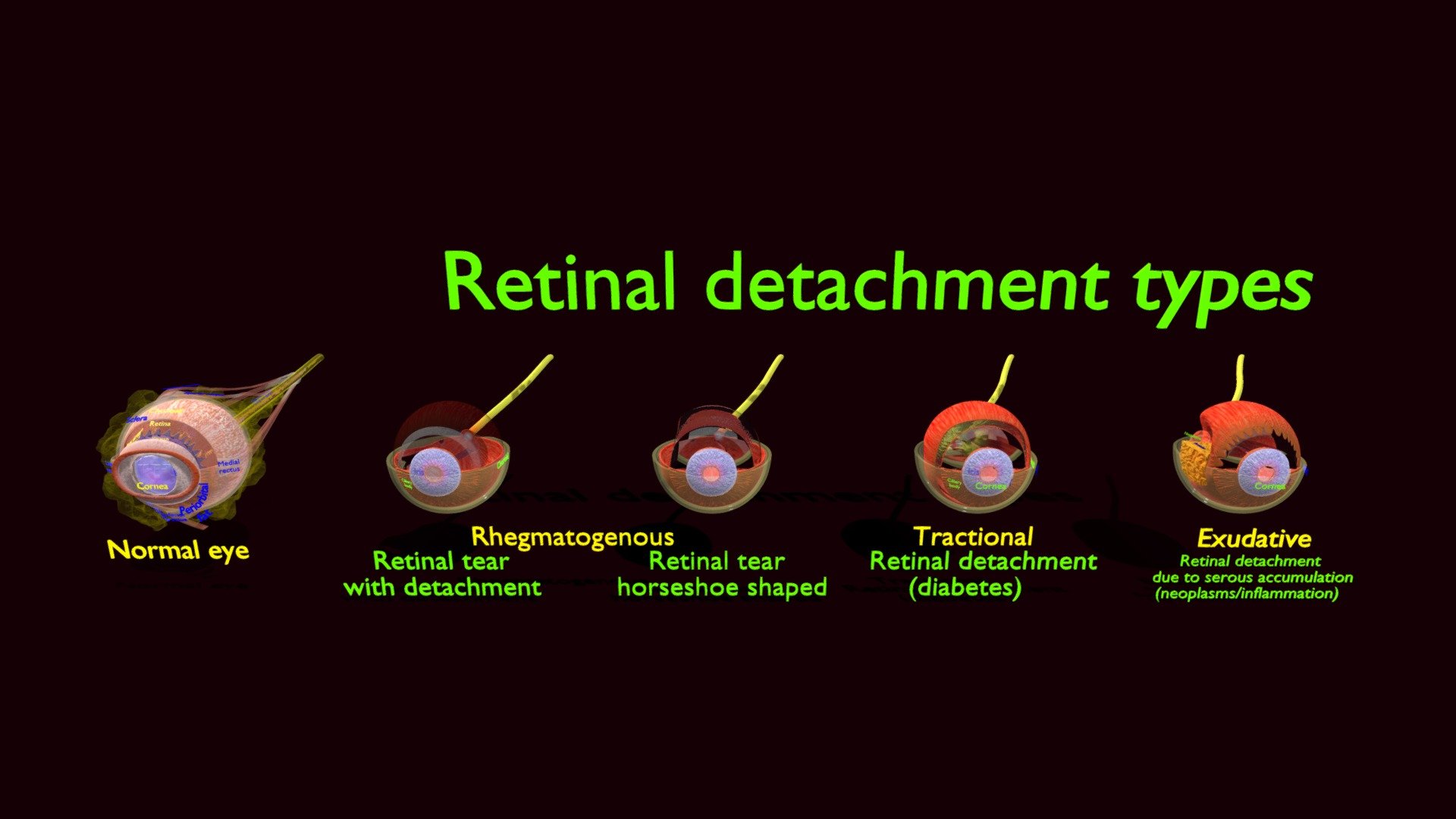 retinal-detachment-types-eye-3d-model-buy-royalty-free-3d-model-by