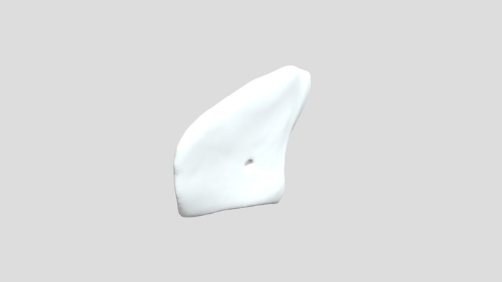 Aneurysmal Bone Cyst 3d reconstruction 3D Model