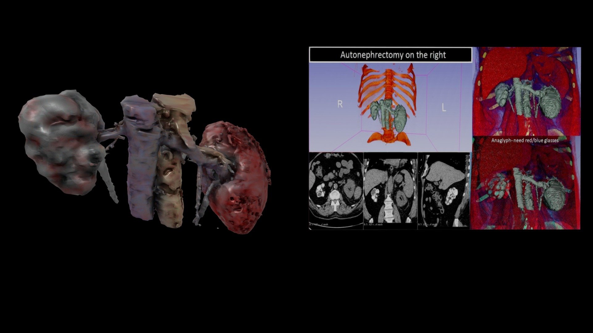 Autonephrectomy
