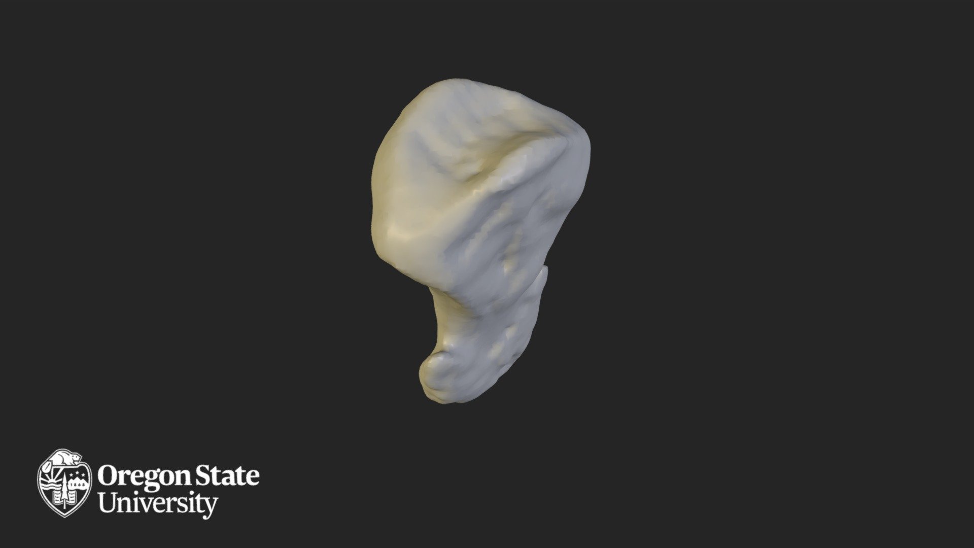Distal Phalange 2