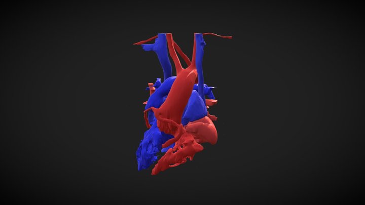 Dextro-DORV 3D Model