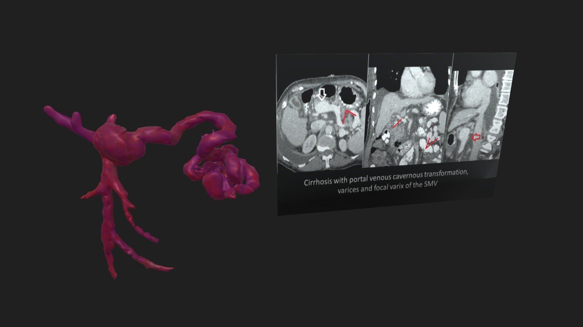 Focal Varix of the SMV with Cirrhosis