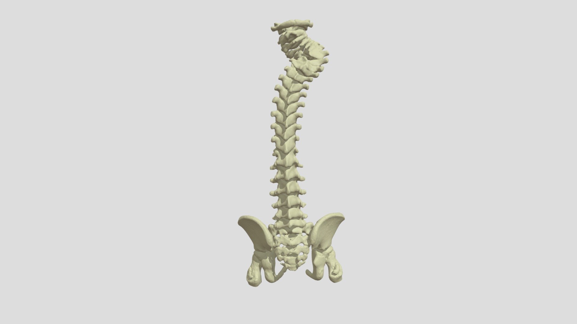 Spine Deformity (S0391) - 3D model by NCH Advanced Projects Laboratory ...