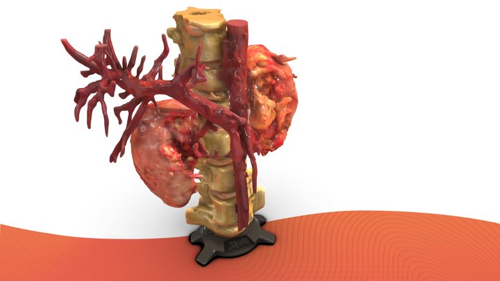 Kidney Disease 3D Model