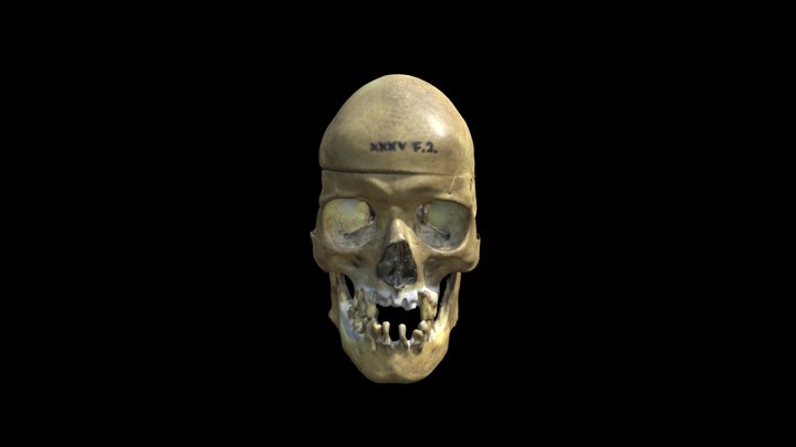 Scaphocephalic Skull 3D Model