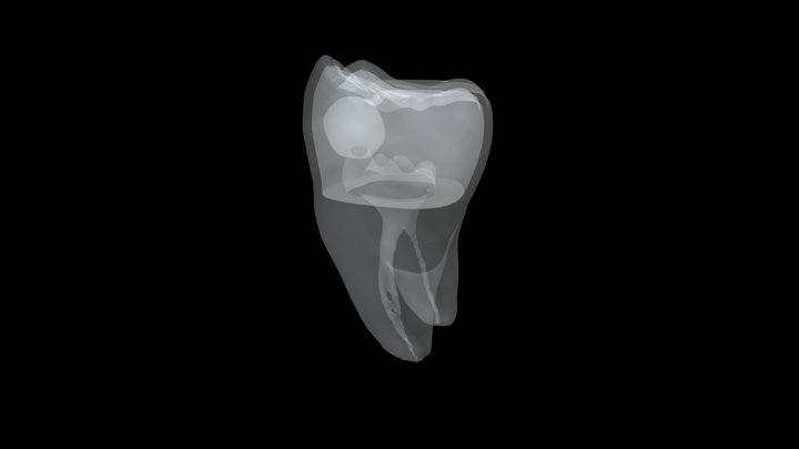 Molar #19 Decay on mesial pulp horn 3D Model