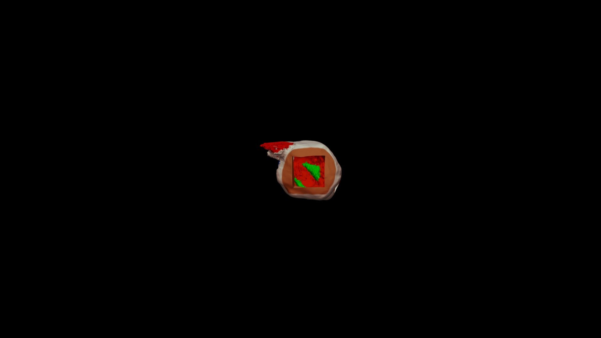 Left Ventricular Aneurysm - 3D model by Imre J. Barabás, MD, M.Sc ...