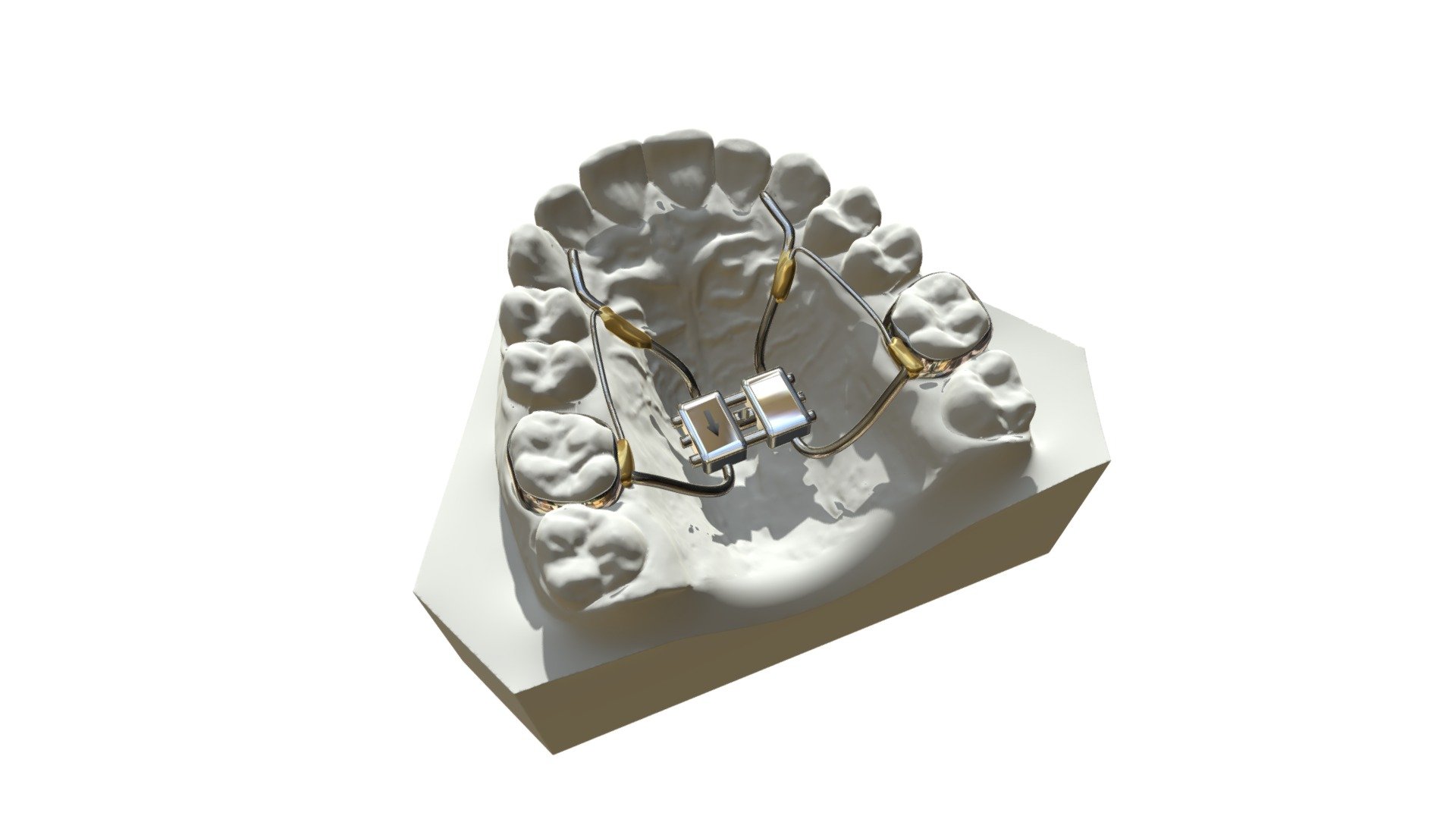 Rapid Palatal Expander - Buy Royalty Free 3D model by Davide Specchi ...