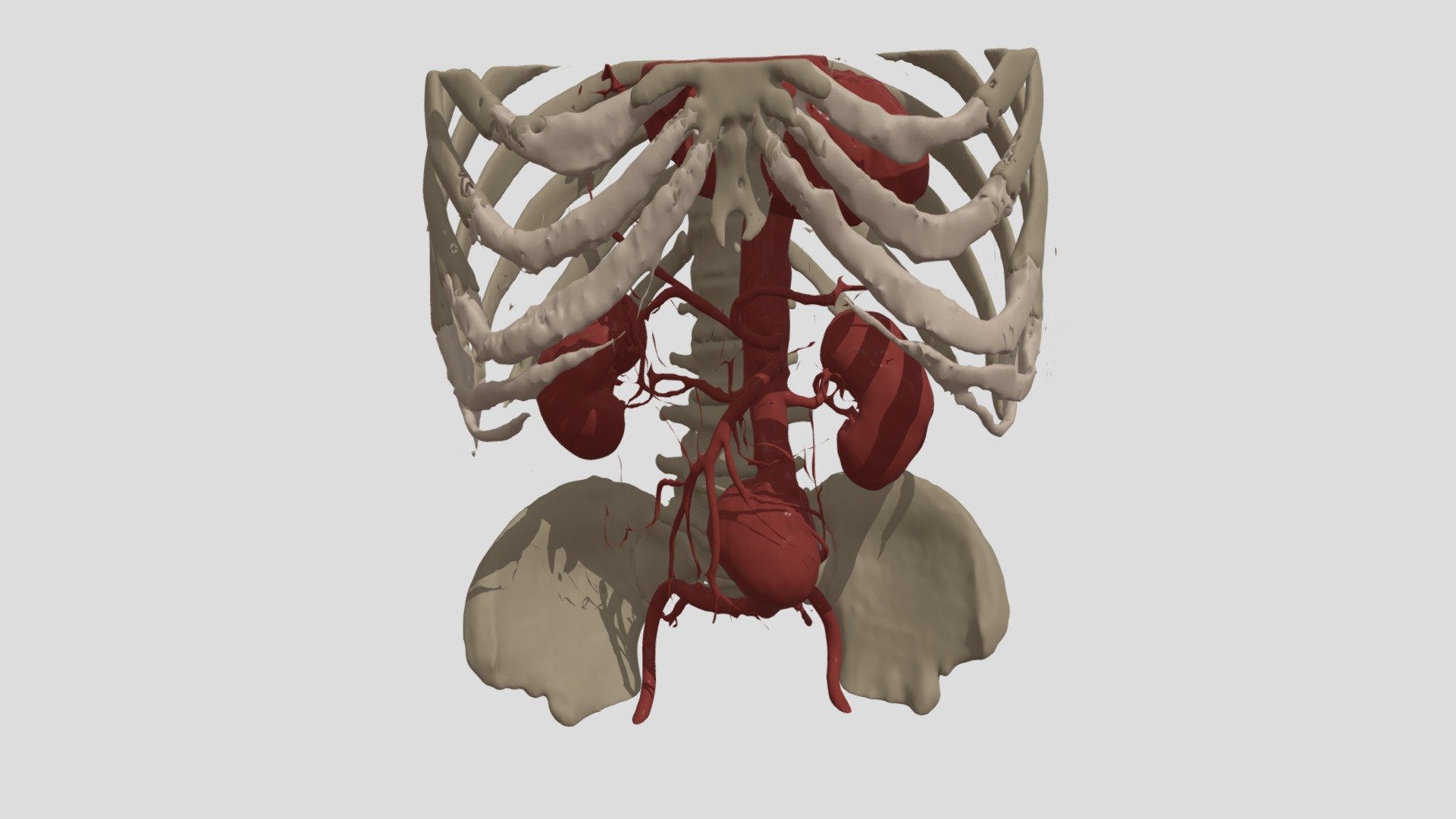 Aneurisma de Aorta abdominal
